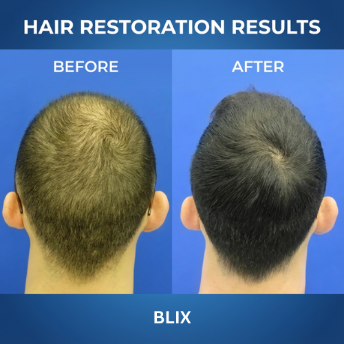 Blix Natural DHT Blocker